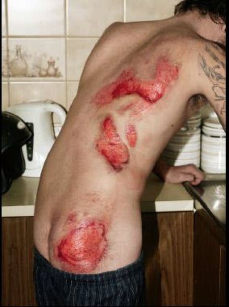 Motorbike rider showing injuries.
